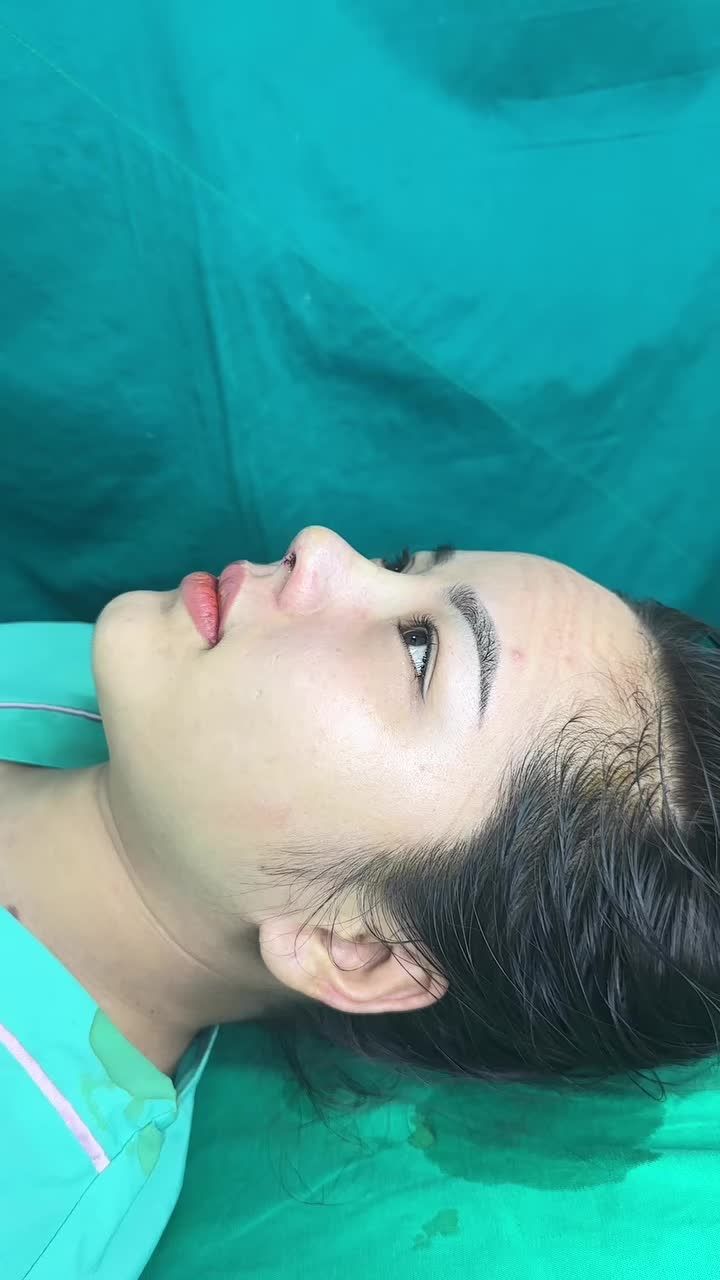 Mũi cấu trúc surgiform vừa hoàn thành