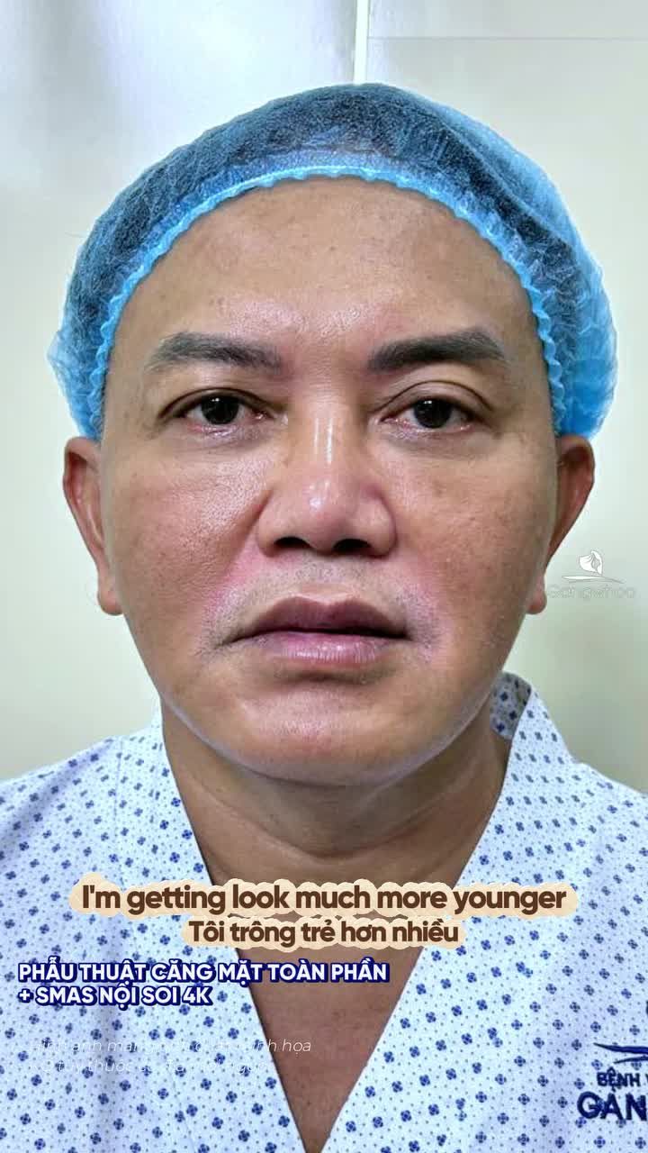 Trẻ hóa ngoài mong đợi sau phẫu thuật căng da mặt toàn phần + Smas nội soi 4K