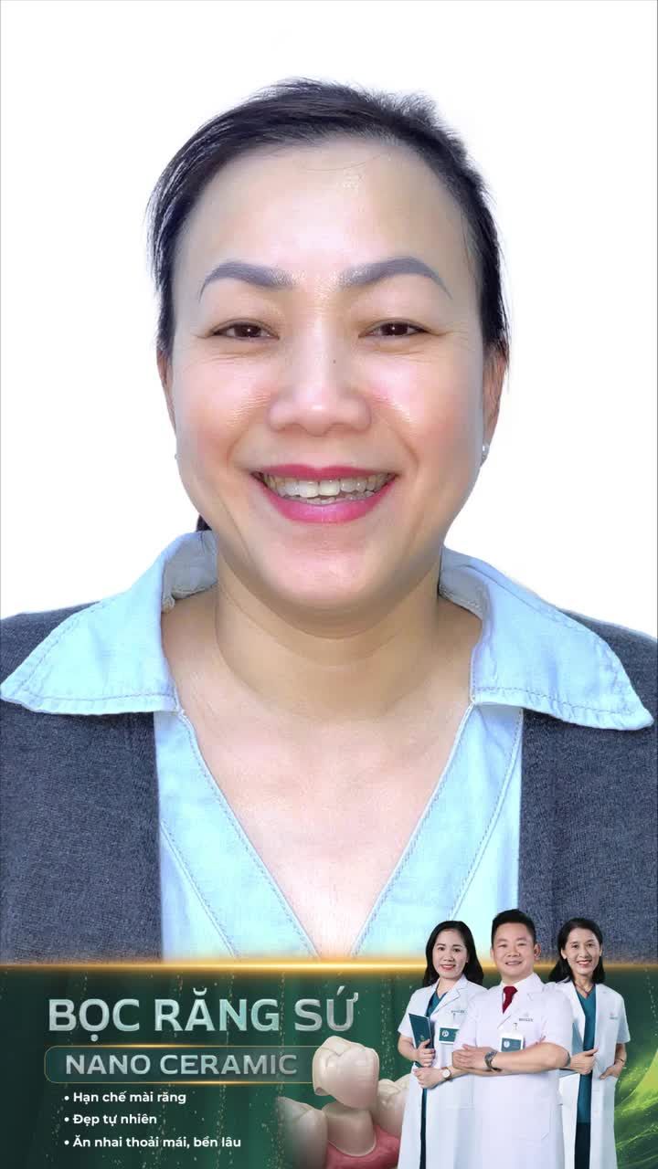 Giải pháp cho răng nhiễm tetracyclin