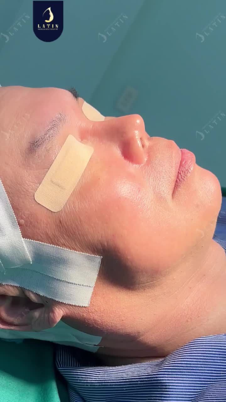 25 NĂM SAU CA MŨI Ở MỸ... VÀ QUYẾT ĐỊNH SỬA LẠI TẠI VIỆT NAM