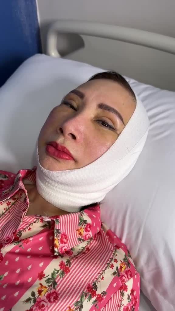 NÓNG: U70 Việt kiều Canada CẮT DA DƯ, XÓA SỤP MI trẻ 20 tuổi với Căng da mặt SMAS PRO và Trᴇᴏ ᴄhâɴ mày tại JW