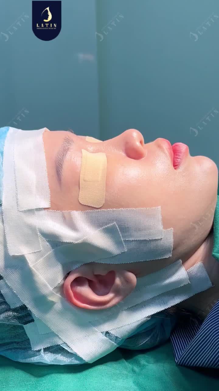 NÂNG MŨI BÁN CẤU TRÚC - "CỨU CÁNH" CHO DÁNG MŨI THẤP, CÁNH MŨI BÈ
