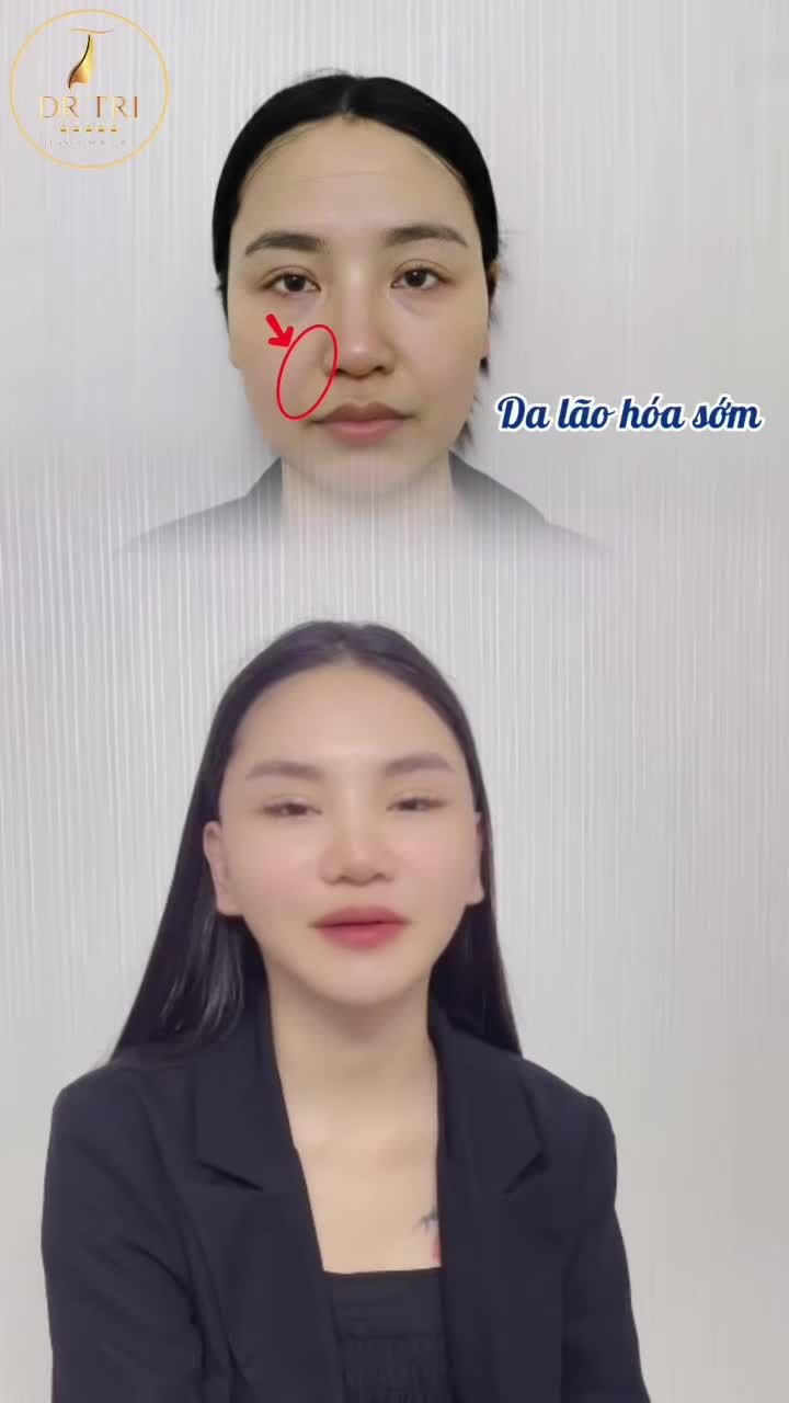 Chia Sẻ Của Khách Hàng Sau Khi Căng Da Mặt Tại Dr. Trí