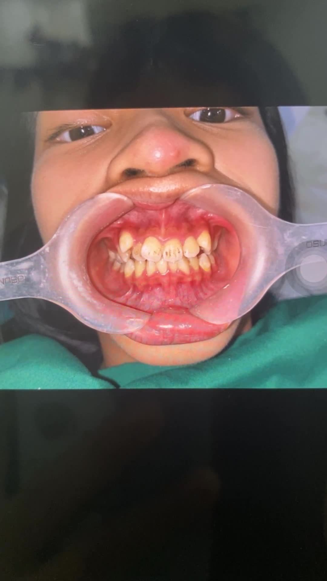 Niềng răng cho bạn khách hàng