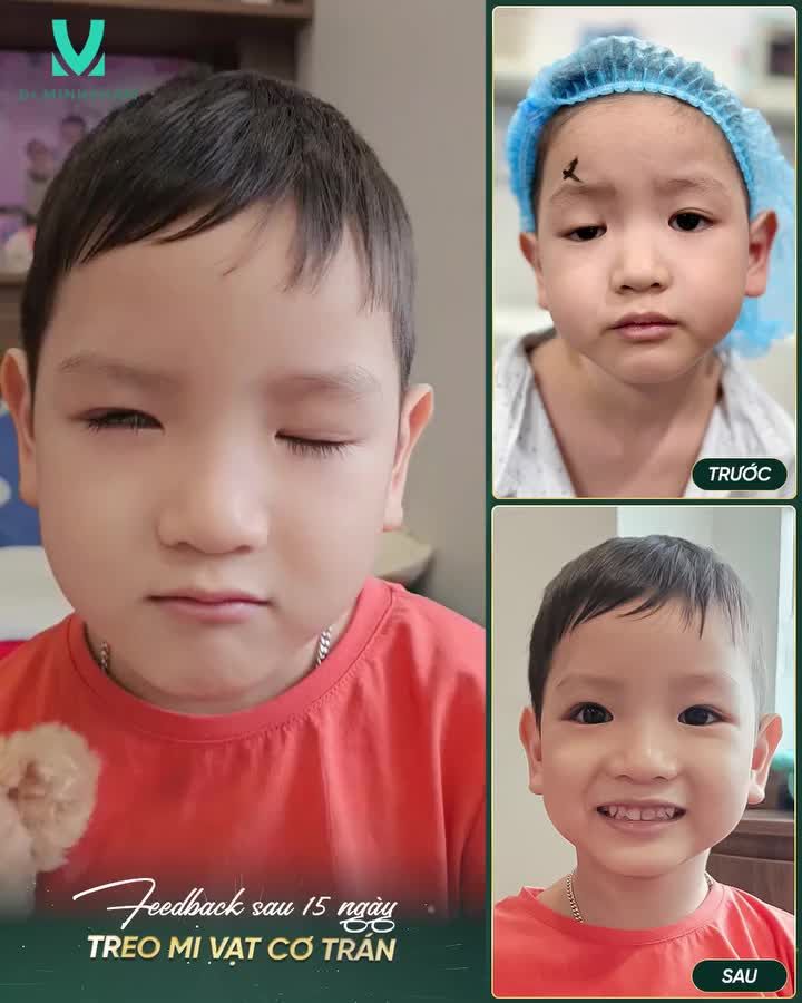 Sau 15 ngày can thiệp sụp mi bẩm sinh, bé đã có sự thay đổi rõ rệt và tích cực