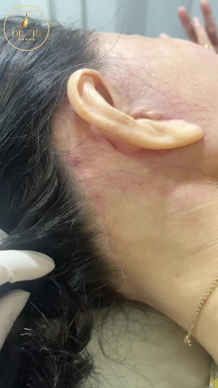 Kết quả sau 3 tháng chị khách sử dụng dịch vụ căng da V_line tại Tiến Sĩ Trí :