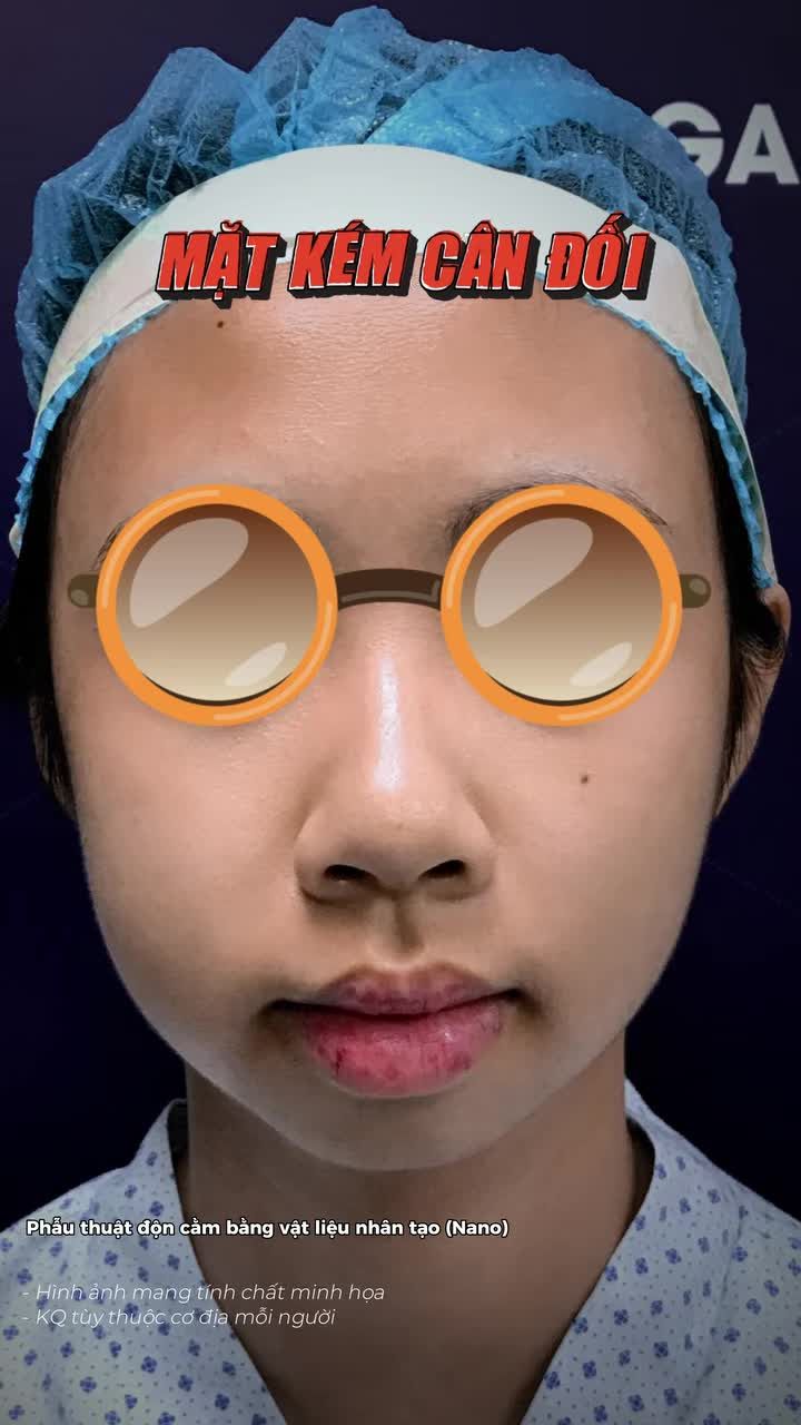 Khắc phục cằm ngắn, lẹm chỉ sau 60 phút phẫu thuật độn cằm bằng vật liệu nhân tạo (Nano)
