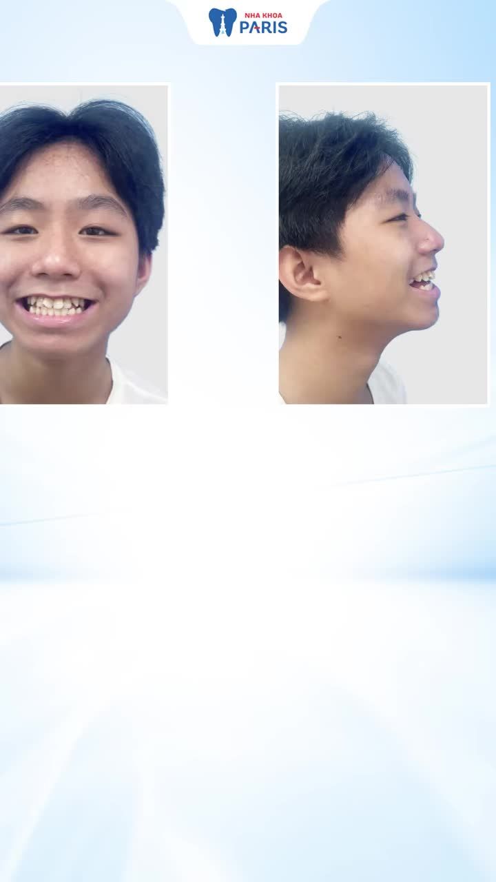 Đầu tư 32 củ - Tháo niềng sau 1,5 năm thì có hài lòng không?