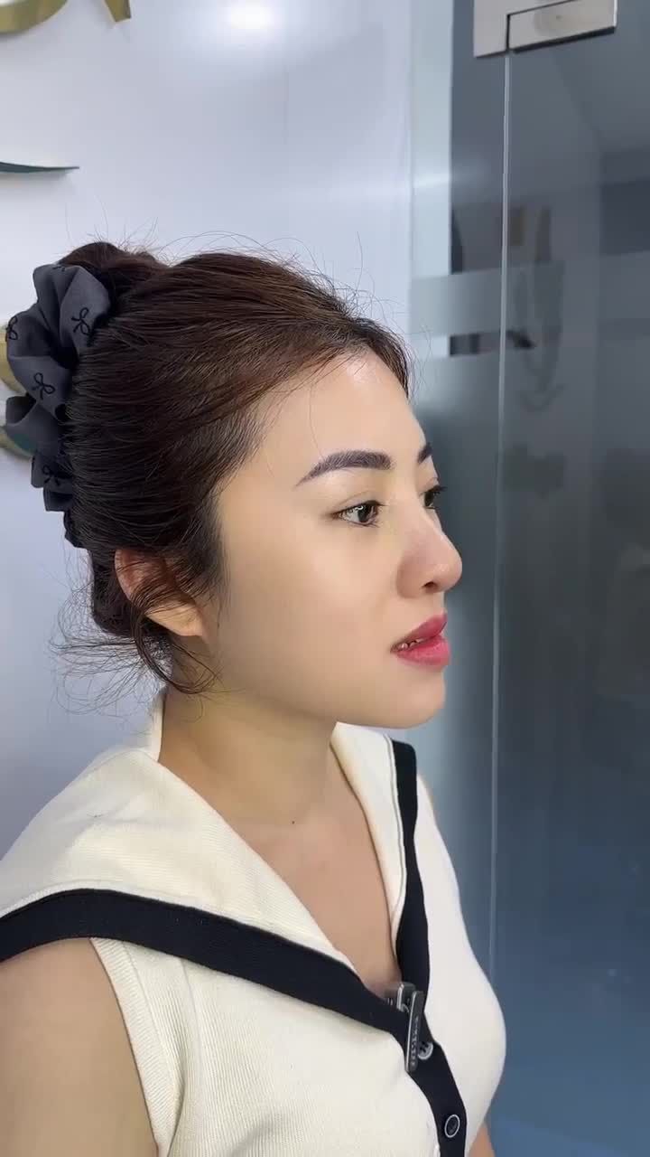 KẾT QUẢ NÂNG MŨI CẤU TRÚC - CẮT CHỈ SAU 10 NGÀY | KH. THANH HIỀN