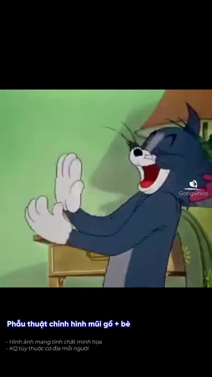 Khách hàng quốc tế vui mừng sau khi thoát khỏi mũi gù và rộng (Phẫu thuật sửa mũi gù rộng)