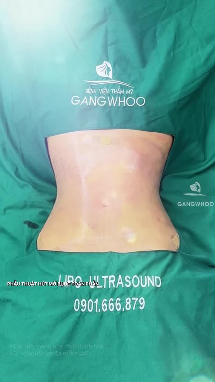 Hành trình trước - sau 60 phút - sau 1 ngày phẫu thuật hút mỡ bụng toàn phần của mẹ 2 con tại BVTM Gangwhoo