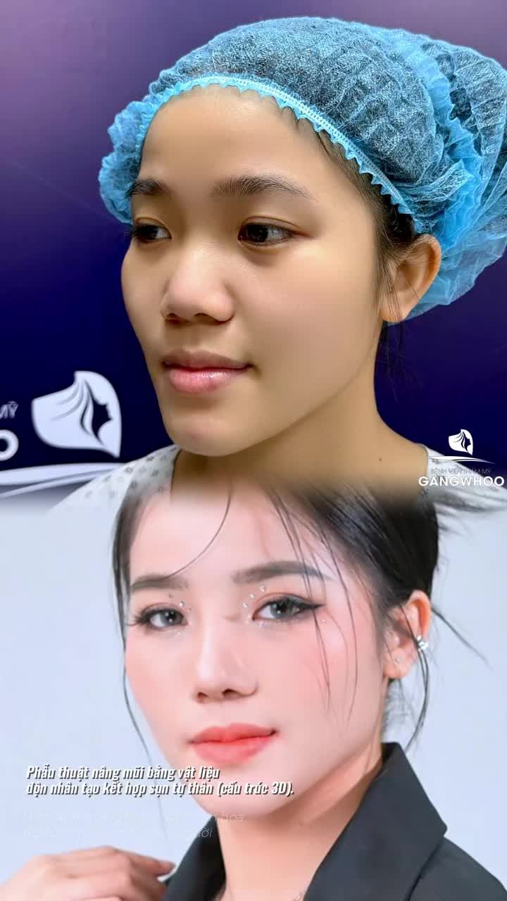 Cặp bạn thân cùng đi nâng mũi, bạn thấy dáng mũi nào đẹp hơn. Phẫu thuật nâng mũi bằng vật liệu độn nhân tạo kết hợp sụn tự thân (cấu trúc 3D)