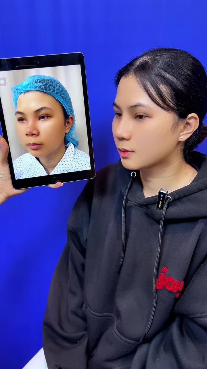 TÁI KHÁM] SAU 15 NGÀY NÂNG MŨI BỌC SỤN: KHÁCH HÀNG "THAY ĐẦU", GƯƠNG MẶT NHỎ GỌN HƠN BẤT NGỜ