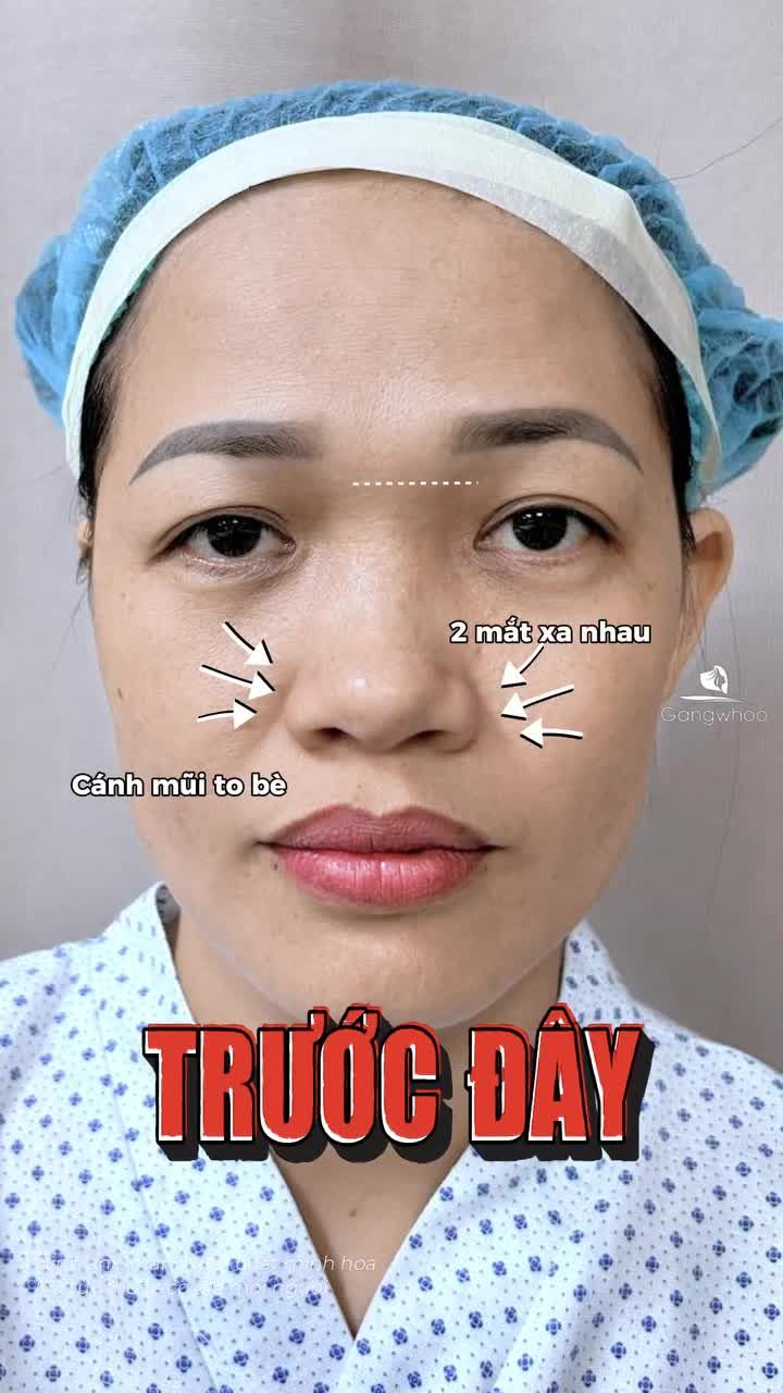 Biết vậy đi nâng mũi sớm hơn. Phẫu thuật nâng mũi bằng vật liệu độn nhân tạo kết hợp sụn tự thân (bọc sụn)