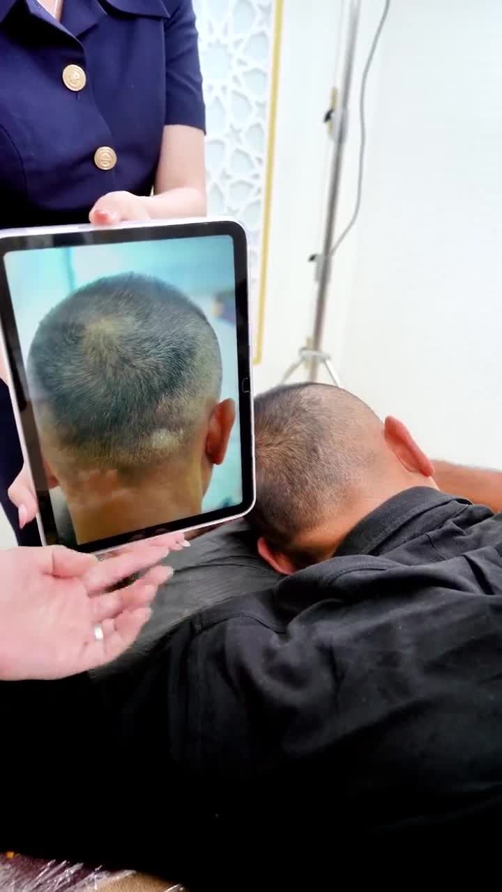 KẾT QUẢ CỦA NGƯỜI MẪU, DIỄN VIÊN DOÃN TUẤN SAU KHI THỰC HIỆN VI CHẠM SẮC TỐ DA ĐẦU TẠI VTM XUÂN HƯƠNG