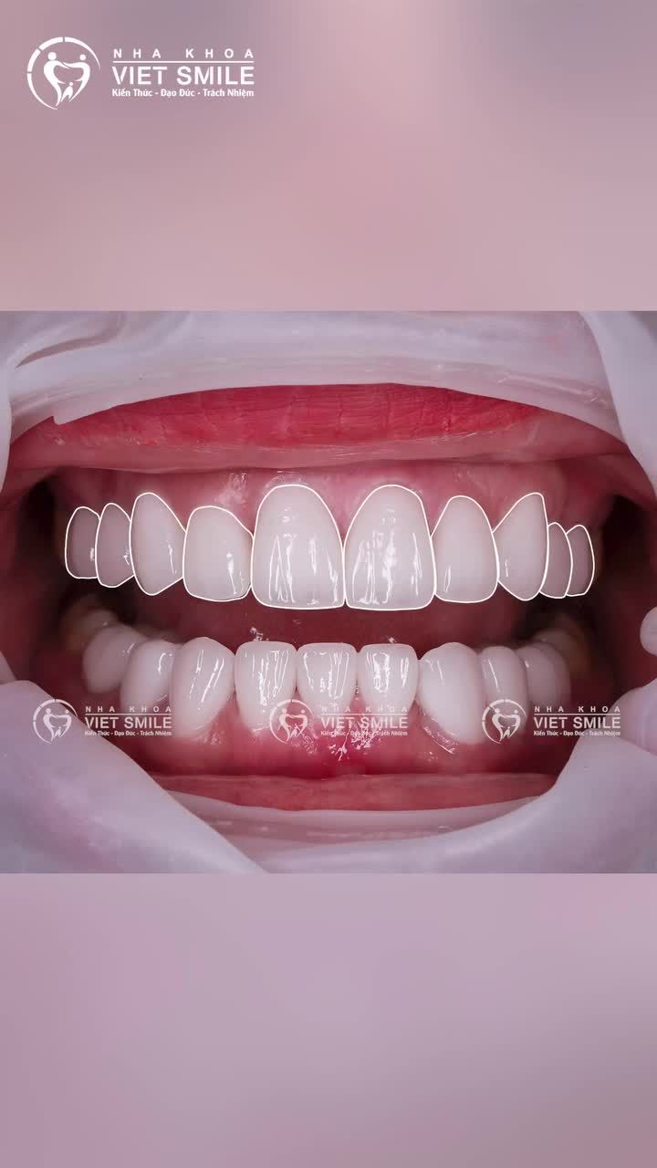 20 răng sứ Lava Plus – Giải pháp cải thiện nụ cười cho khách hàng Việt kiều Mỹ tại Viet Smile