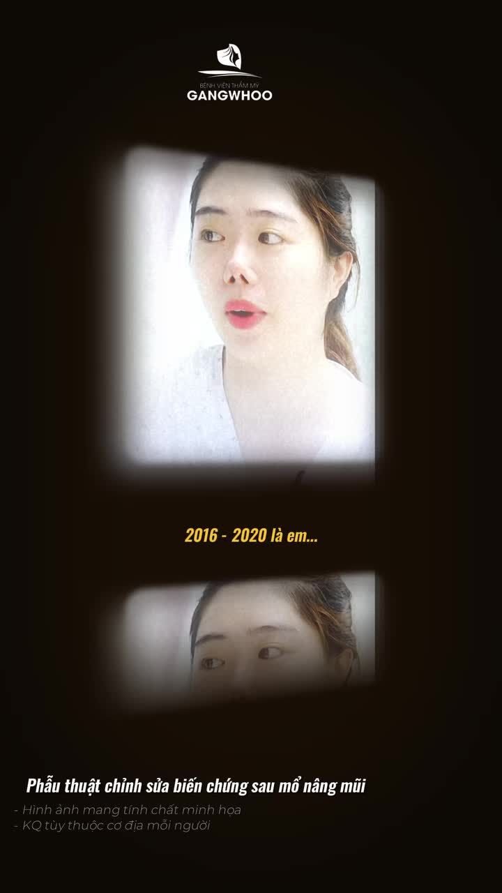 Hành trình 4 lần phẫu thuật chỉnh sửa biến chứng sau mổ nâng mũi để tìm lại diện mạo xinh đẹp