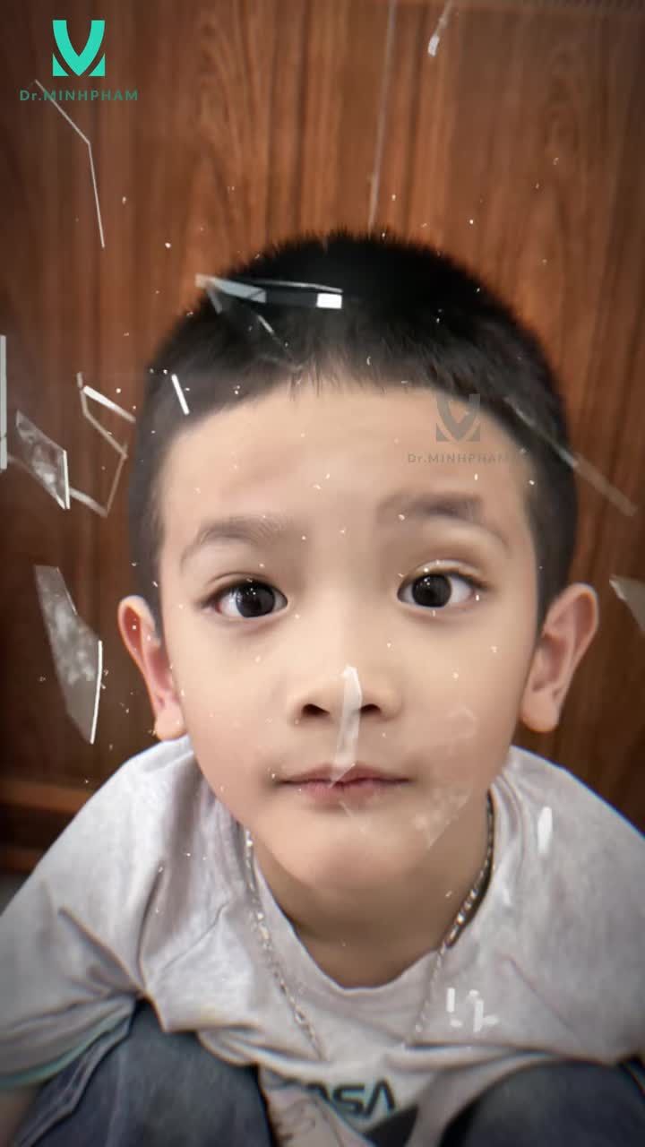 Bé Hải Đăng sau phẫu thuật treo mi vạt cơ trán 3 tháng, đôi mắt to tròn cân đối và có hồn giúp bé tự tin hơn!