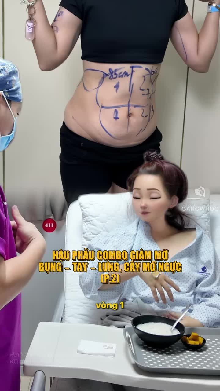 Hậu phẫu khách hàng làm combo giảm mỡ bụng, bắp tay, lưng và cấy mỡ v1 (Phần 2)