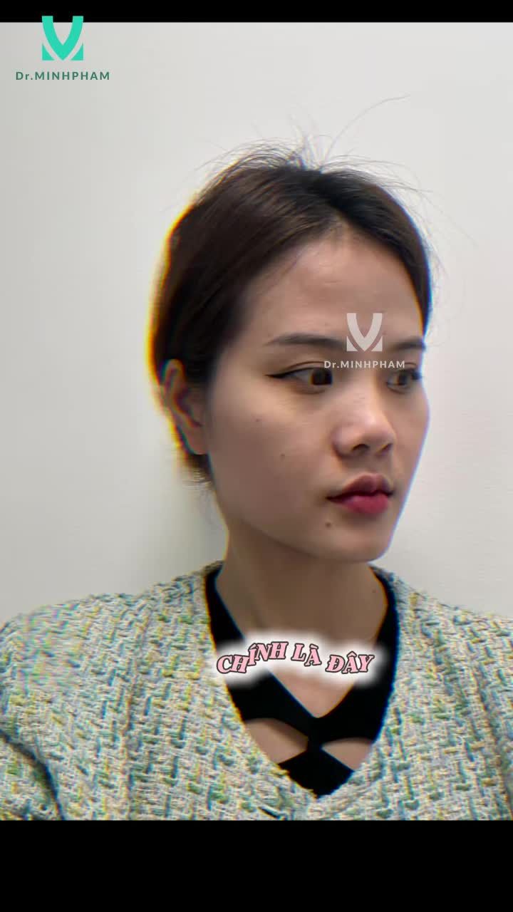 NÂNG MŨI SAU 2 NĂM SẼ NHƯ THẾ NÀO?