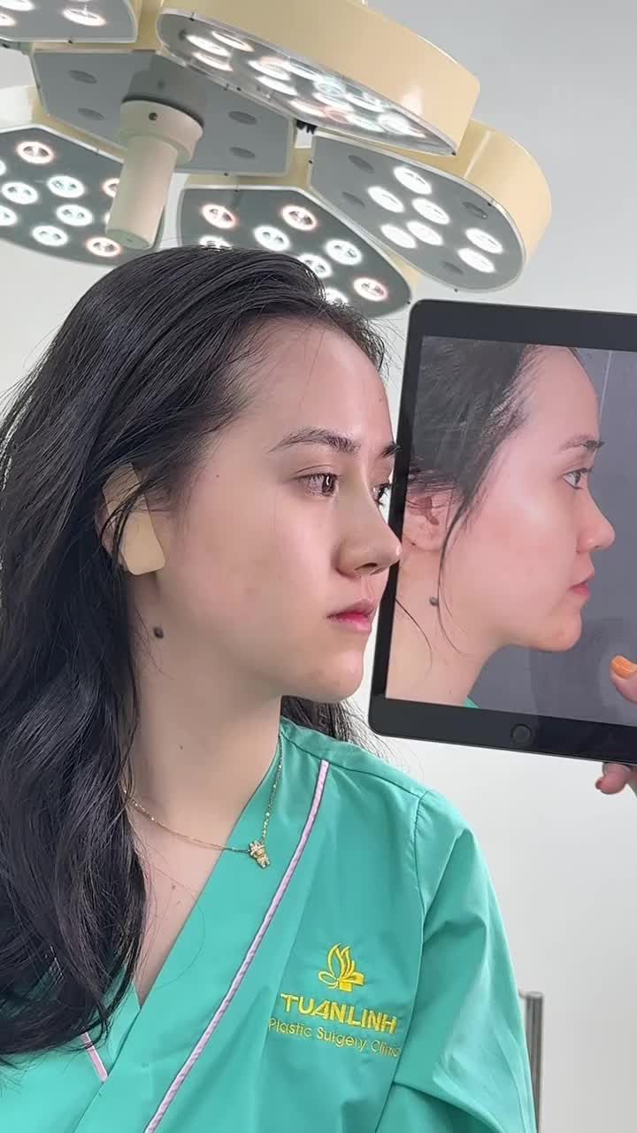 17TR - Sở hữu dáng mũi đẹp trọn vẹn từng đường nét!!