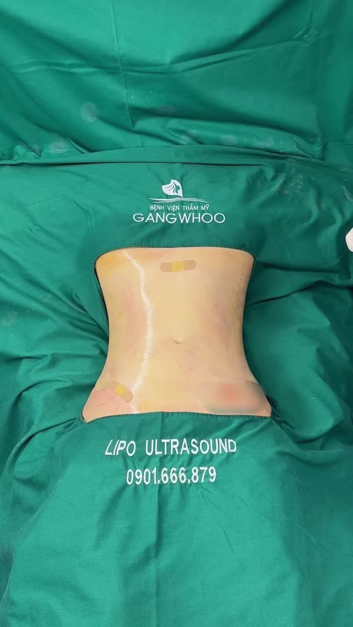 KẾT QUẢ HÚT MỠ LIPO ULTRASOUND: VÒNG EO "LỘT XÁC" NGOẠI MỤC CHO VỊ KHÁCH NƯỚC NGOÀI!