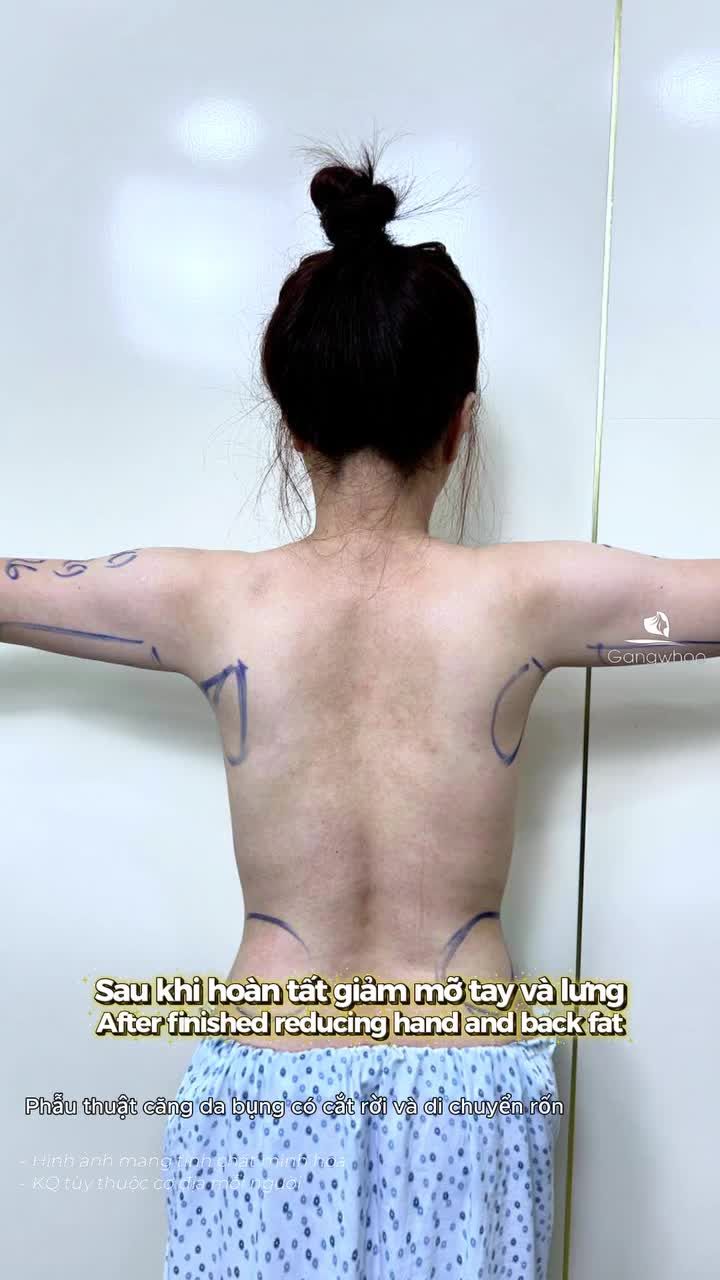 Kết quả phẫu thuật căng da bụng có cắt rời và di chuyển rốn sau 90 phút thực hiện