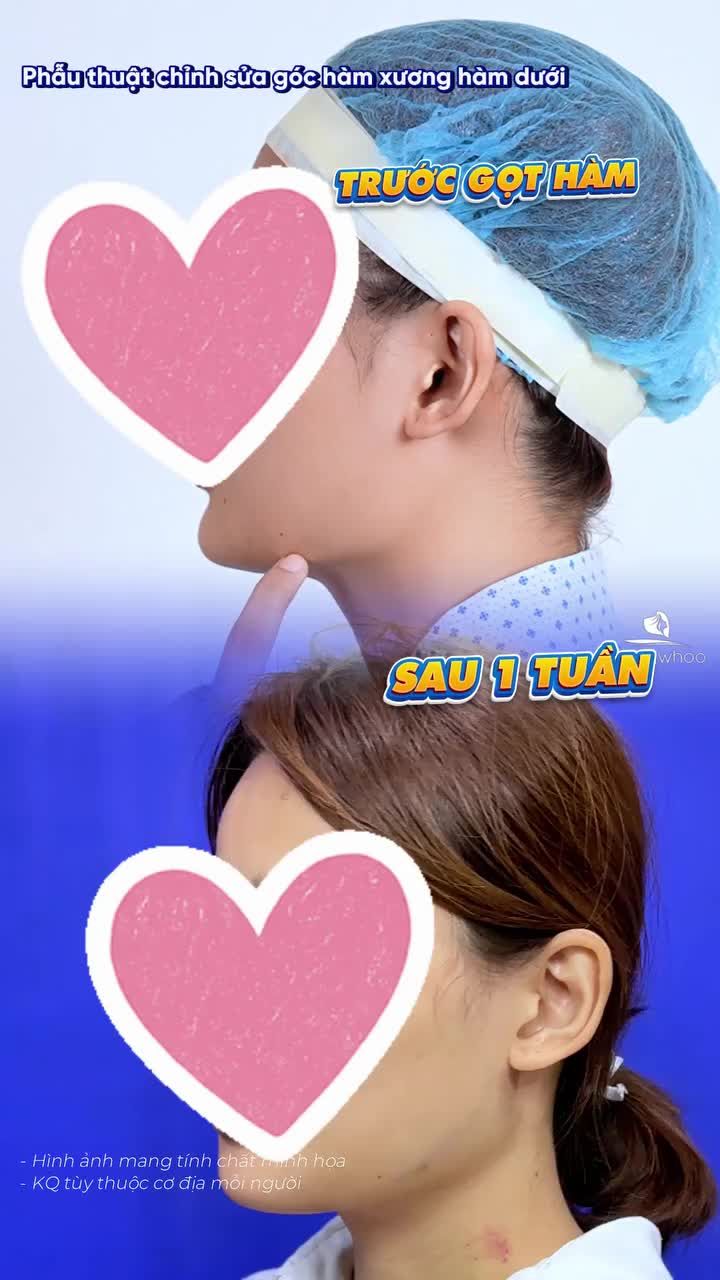 DMKT: Phẫu thuật chỉnh sửa góc hàm xương hàm dưới