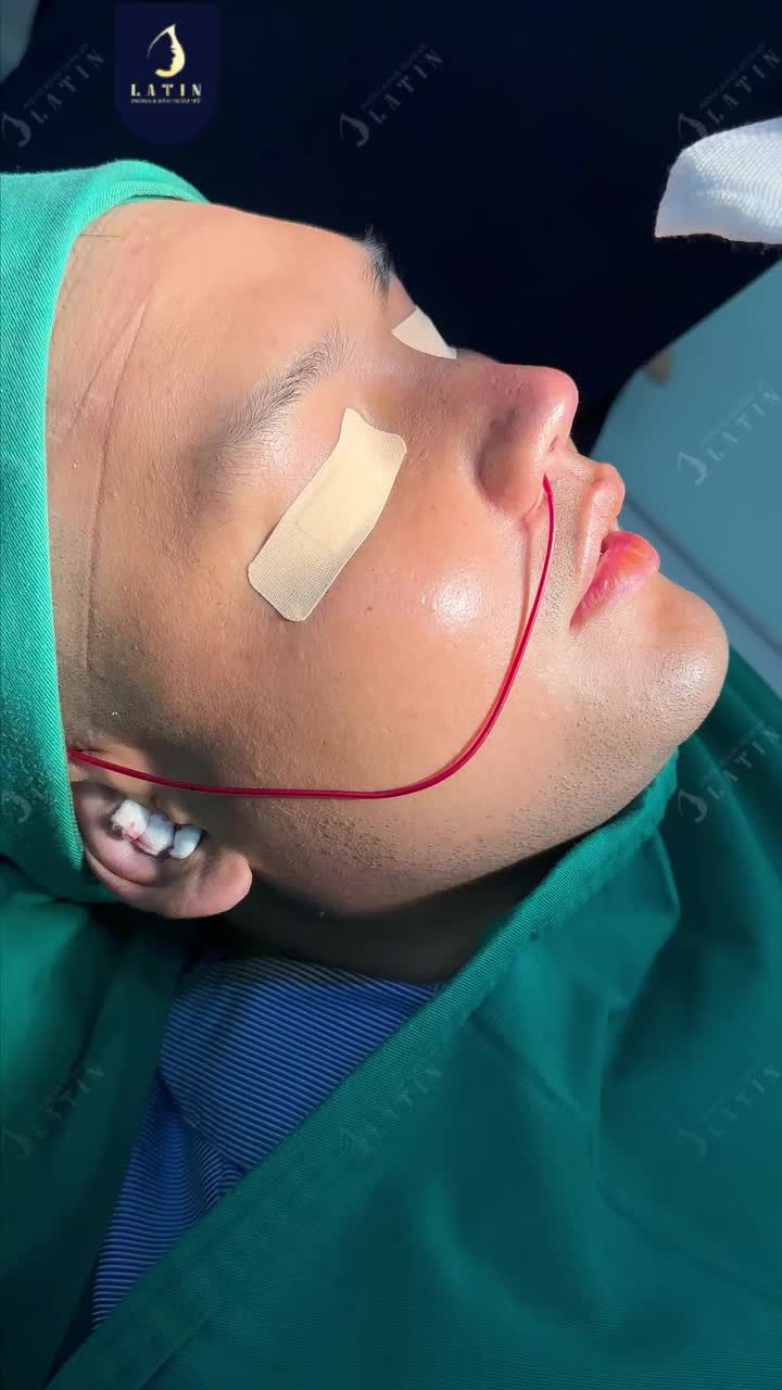 MỘT DÁNG MŨI MỚI VISUAL NAM TÍNH TĂNG GẤP ĐÔI