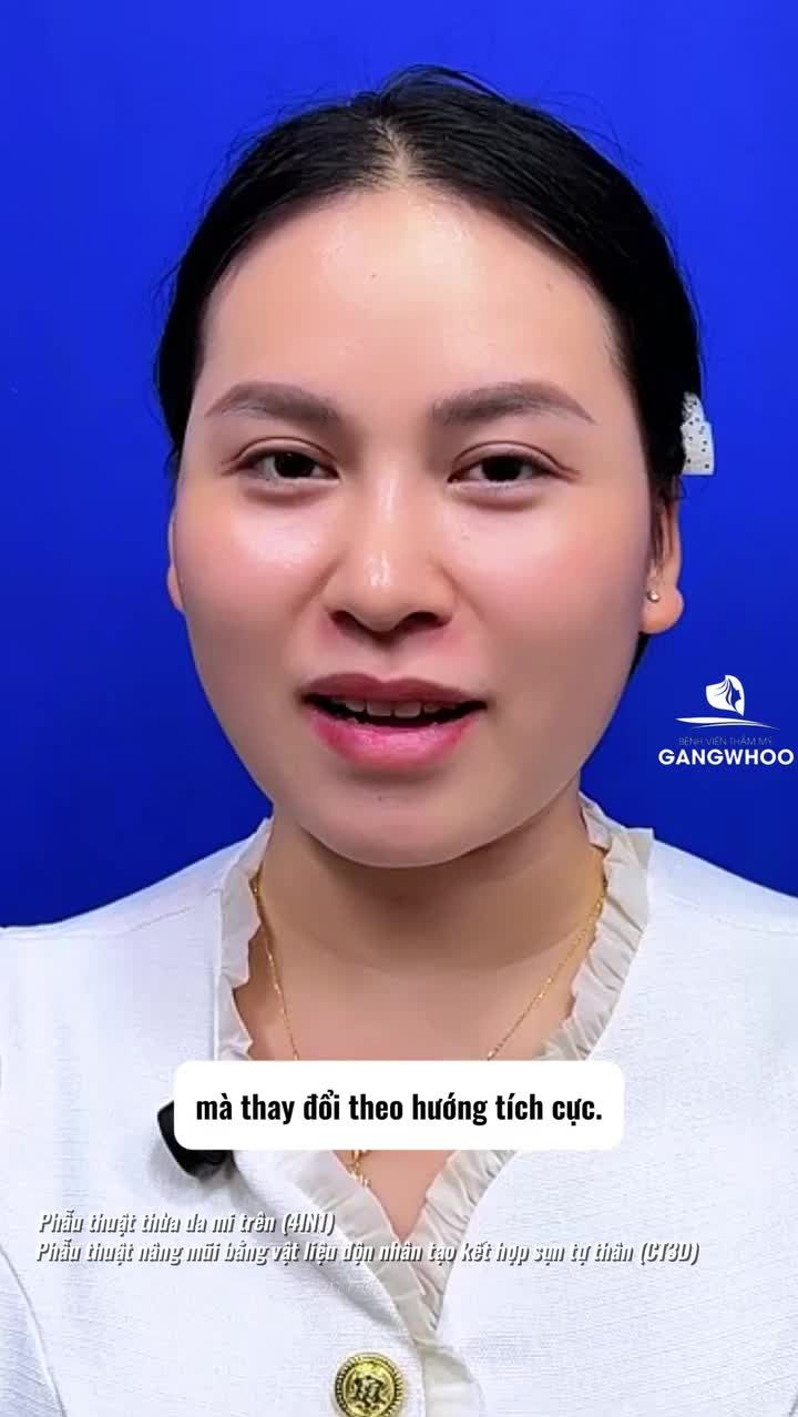 Hơn 1 tháng trôi qua, nhan sắc đã lộ rõ. Cùng Gangwhoo đón chờ lần tái khám tiếp theo để thấy diện mạo rạng rỡ và hoàn thiện hơn nhé!