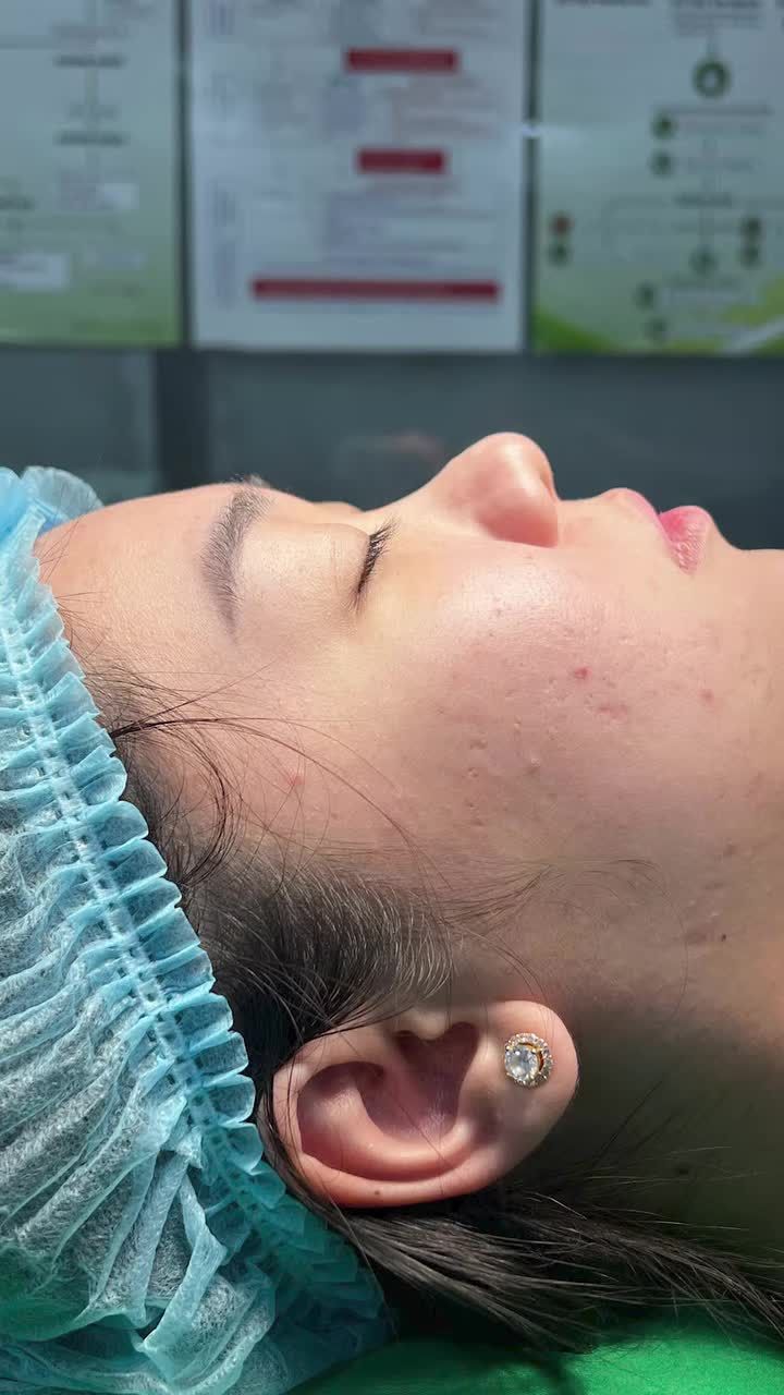 Cách cải thiện mũi củ tỏi.