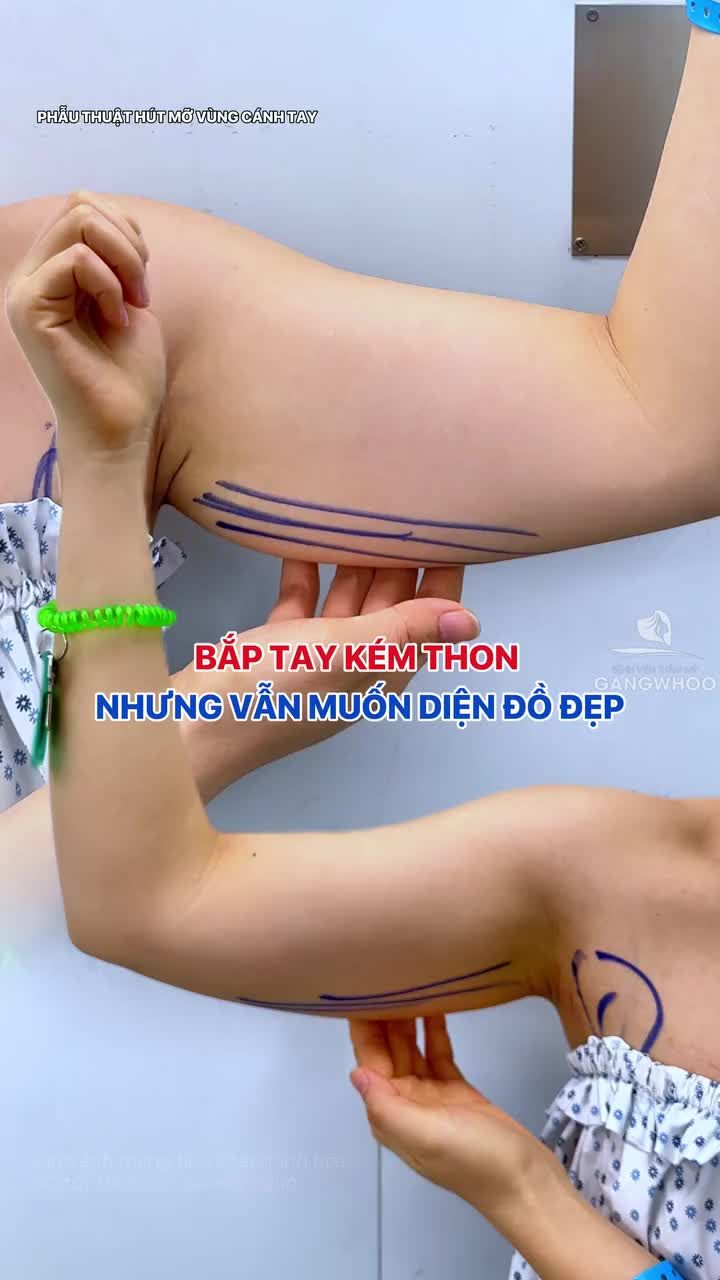 Bắp tay kém thon gọn nhưng vẫn mong muốn tự tin diện áo hai dây, đầm body.