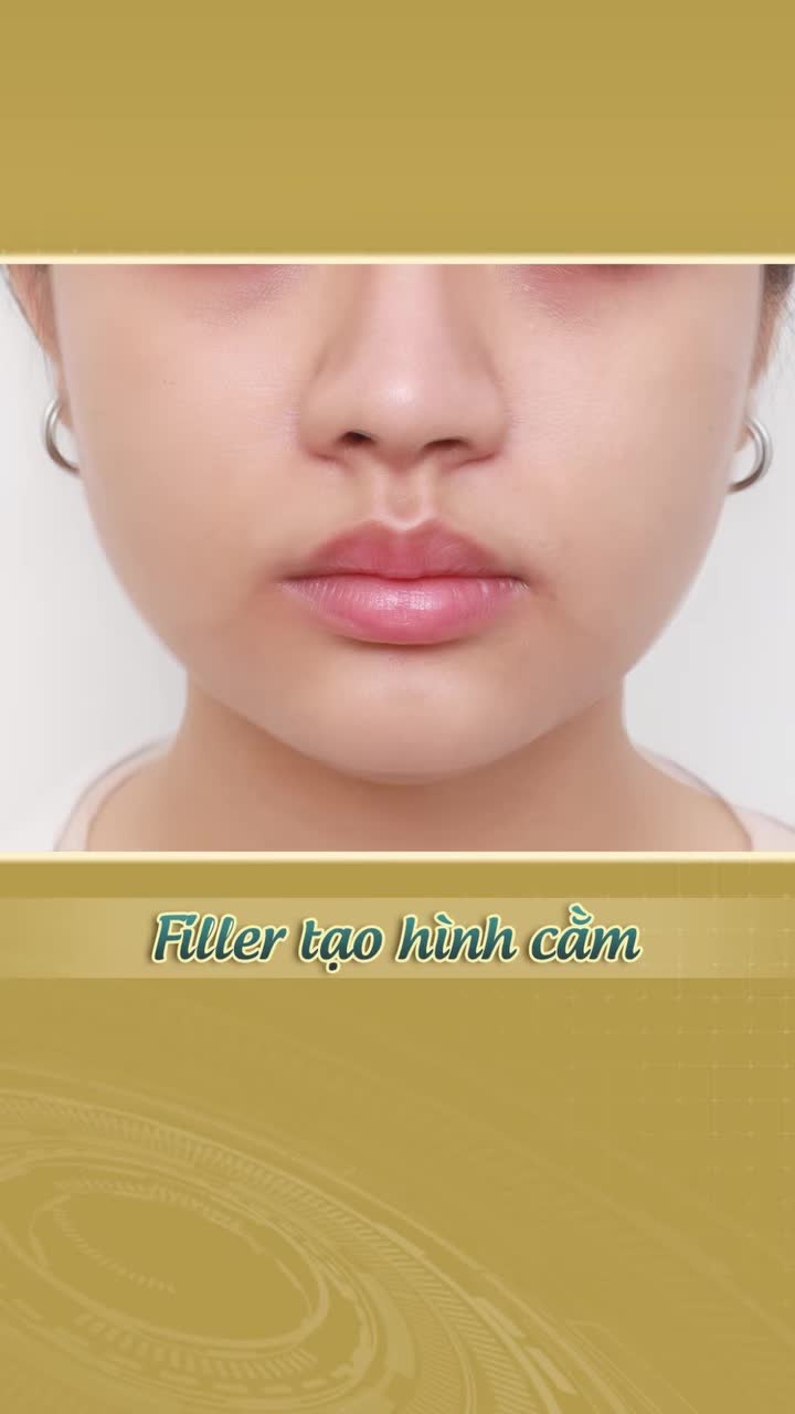 Điều chỉnh dáng cằm cân đối nhanh chóng, an toàn mà không cần can thiệp phẫu thuật