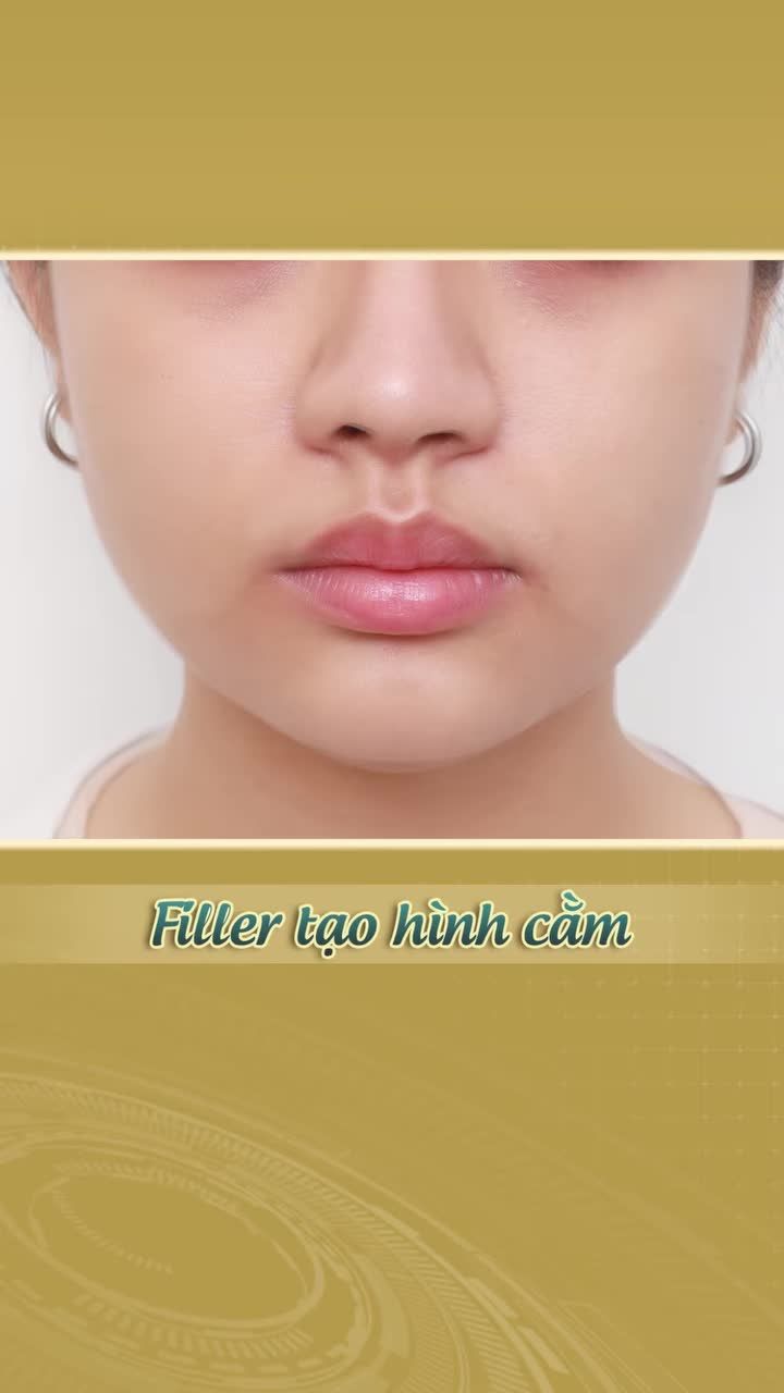 Điều chỉnh dáng cằm cân đối nhanh chóng, an toàn mà không cần can thiệp phẫu thuật