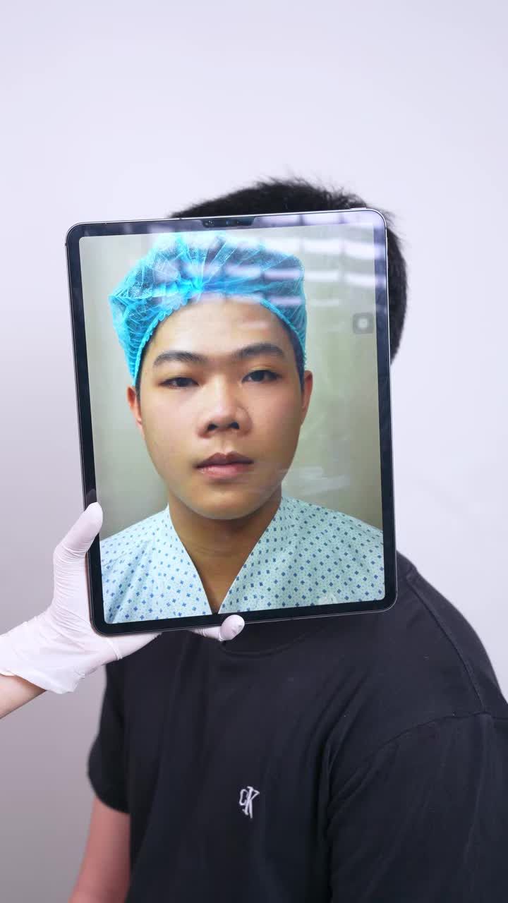 TÁI KHÁM NÂNG MŨI CẤU TRÚC: DIỆN MẠO ĐIỂN TRAI, HÀI HÒA SAU 14 NGÀY TẠI GANGWHOO!