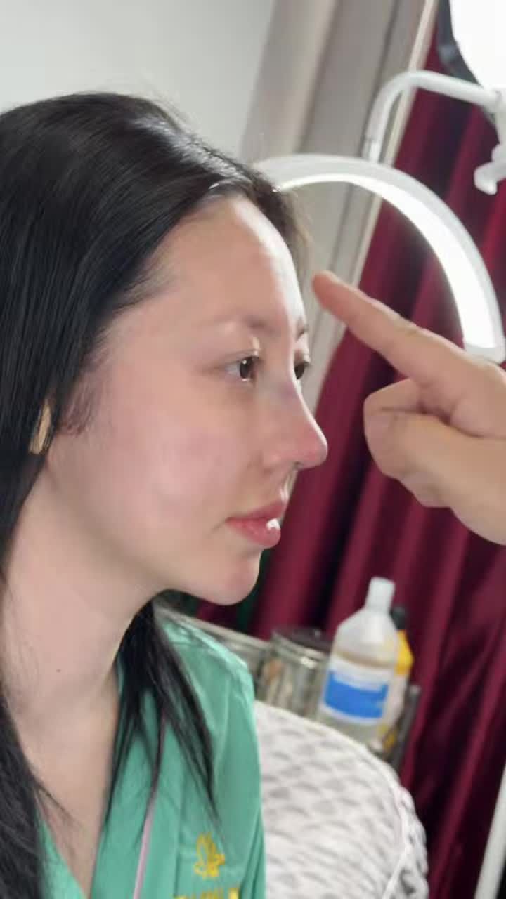 NÂNG MŨI CẤU TRÚC SURGIFORM "PHA KÈ" SAU 1 NĂM BỊ XUỐNG CẤP... SAU KHI NÂNG LẠI TẠI TUẤN LINH 10 NGÀY ĐẸP XUẤT SẮC.