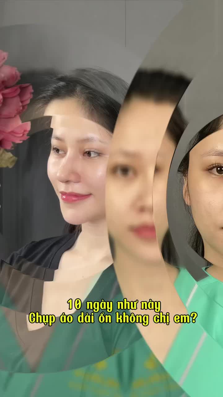 LÀM MŨI SAU 10 NGÀY – CHUẨN ĐẸP, TỰ TIN CHỤP HÌNH TẾT!