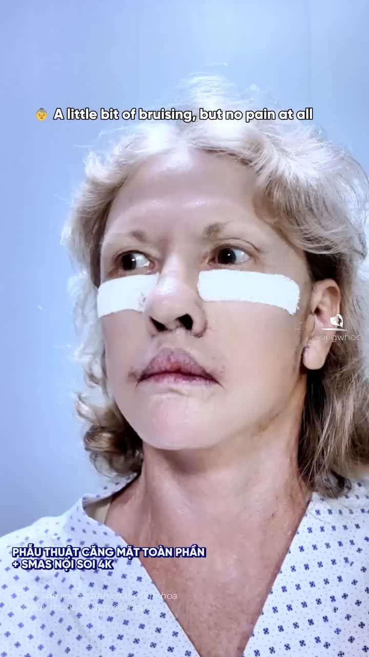 Hành trình thay đổi của chị khách Quốc Tế sau khi Phẫu thuật căng mặt toàn phần + Smas nội soi 4K