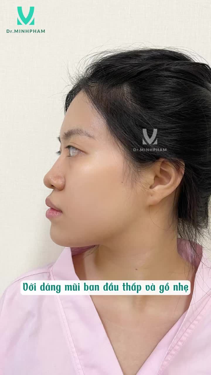 Hành trình nâng mũi để trở thành phiên bản đẹp hơn của bạn Gia Hân