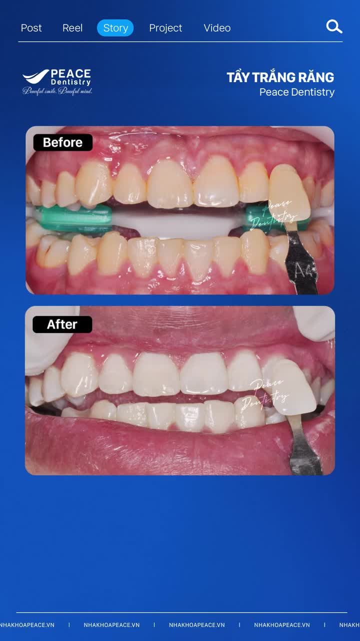 Bạn có biết thế nào là tẩy trắng răng an toàn?