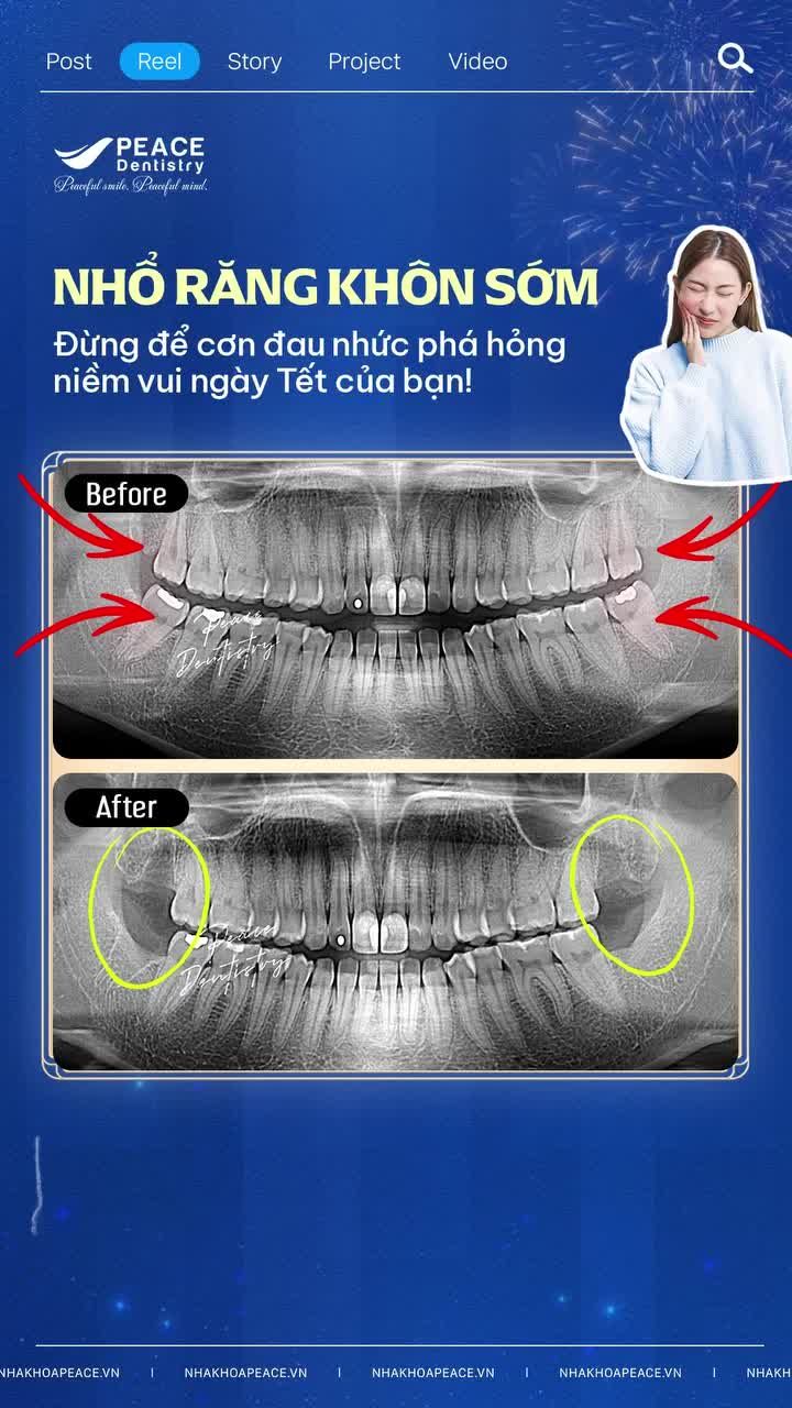 Việc trì hoãn nhổ răng khôn sẽ gây ra rất nhiều phiền toái, đặc biệt là vào những ngày lễ cuối năm, dịp cận Tết.