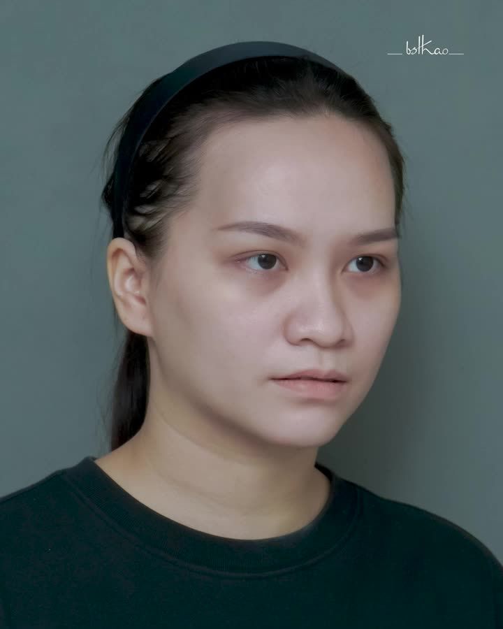 CẢI THIỆN KHUYẾT LÕM KHUÔN MẶT - LẤY LẠI NÉT TƯƠI TRẺ NHỜ CẤY MỠ