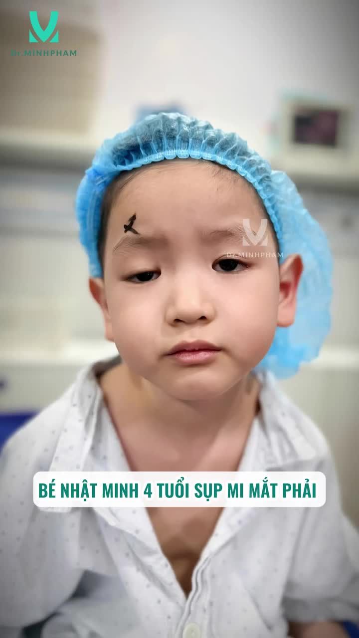 Phẫu thuật sụp mi bẩm sinh - không chỉ là thẩm mỹ, mà là tương lai thị lực của trẻ