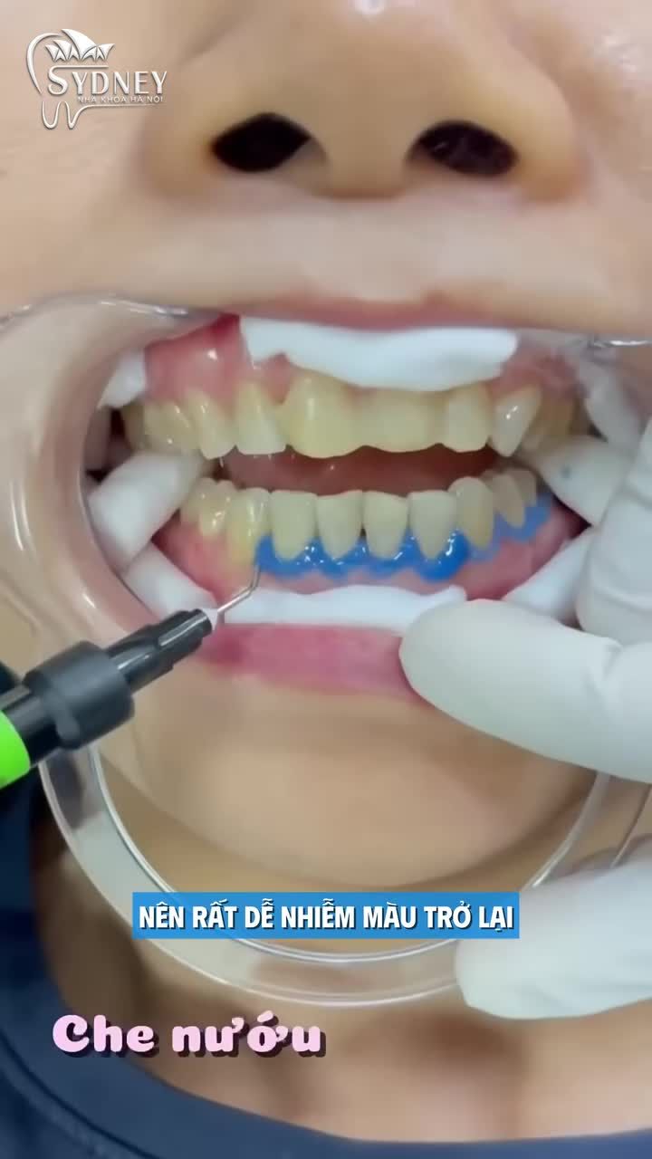 Tấy trắng răng cần kiêng thực phẩm có màu trong bao lâu?