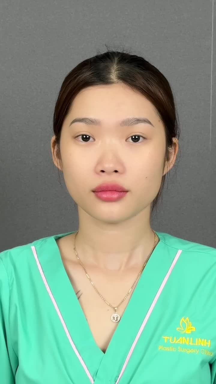 MŨI 10 NGÀY – ĐẸP NHƯ CHƯA HỀ CAN THIỆP