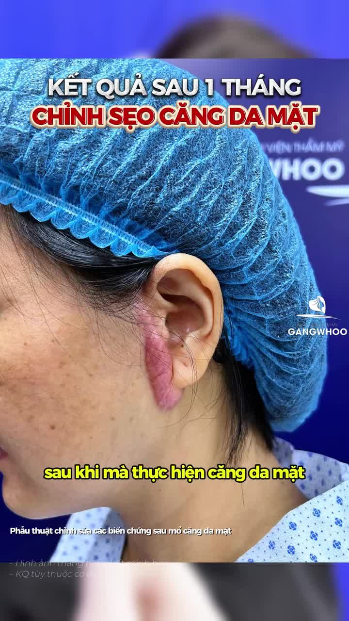 Kết quả sửa sẹo sau 1 tháng căng da mặt kém chất lượng tại nơi khác được bác sĩ thăm khám và dặn dò chăm sóc kỹ lưỡng hơn.