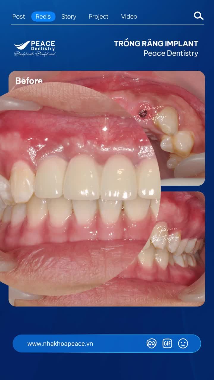 Thay thế răng mất bằng implant, bên cạnh việc khôi phục chức năng ăn nhai ổn định, tự nhiên và thẩm mỹ thì Implant còn là lựa chọn đầu tư bền vững.