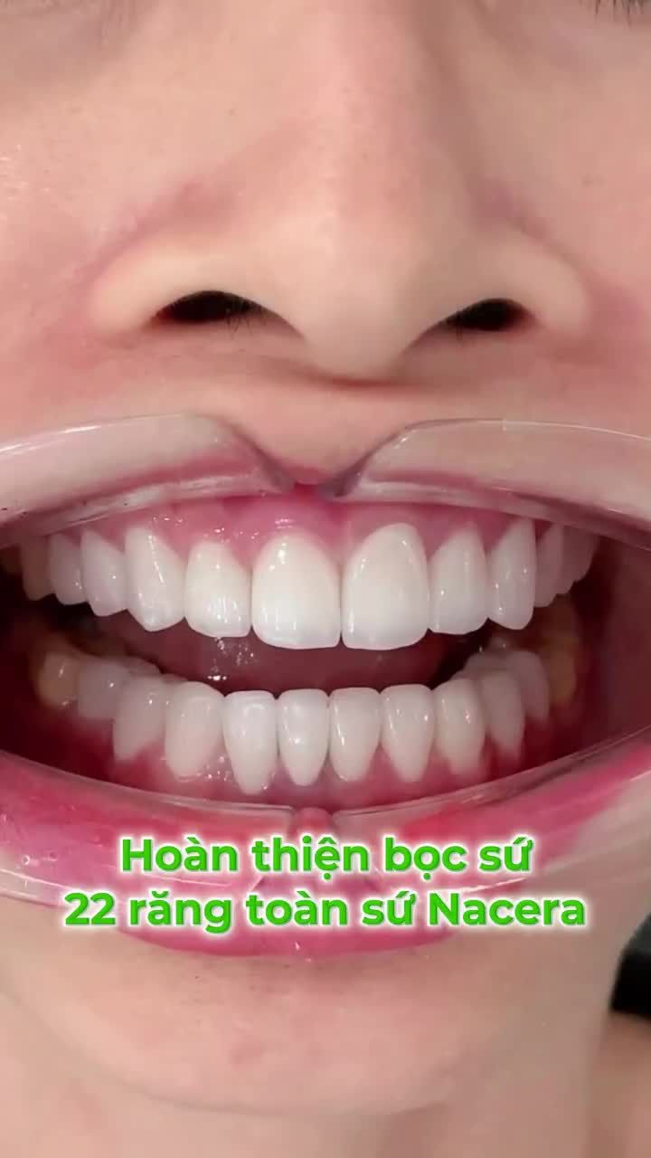 HOÀN THIỆN NỤ CƯỜI 22 RĂNG TOÀN SỨ NACERA – ĐẲNG CẤP TỪ CHẤT LIỆU ĐẾN TỪNG ĐƯỜNG NÉT
