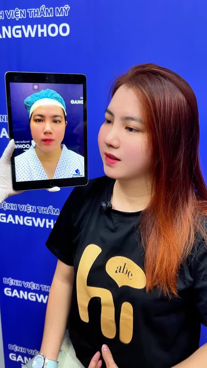 VƯỢT QUA NỖI SỢ ĐAU VÀ CƠ ĐỊA DỮ: TRẢI NGHIỆM NÂNG MŨI CẤU TRÚC THÀNH CÔNG CỦA CHỊ THẢO (HÓC MÔN)