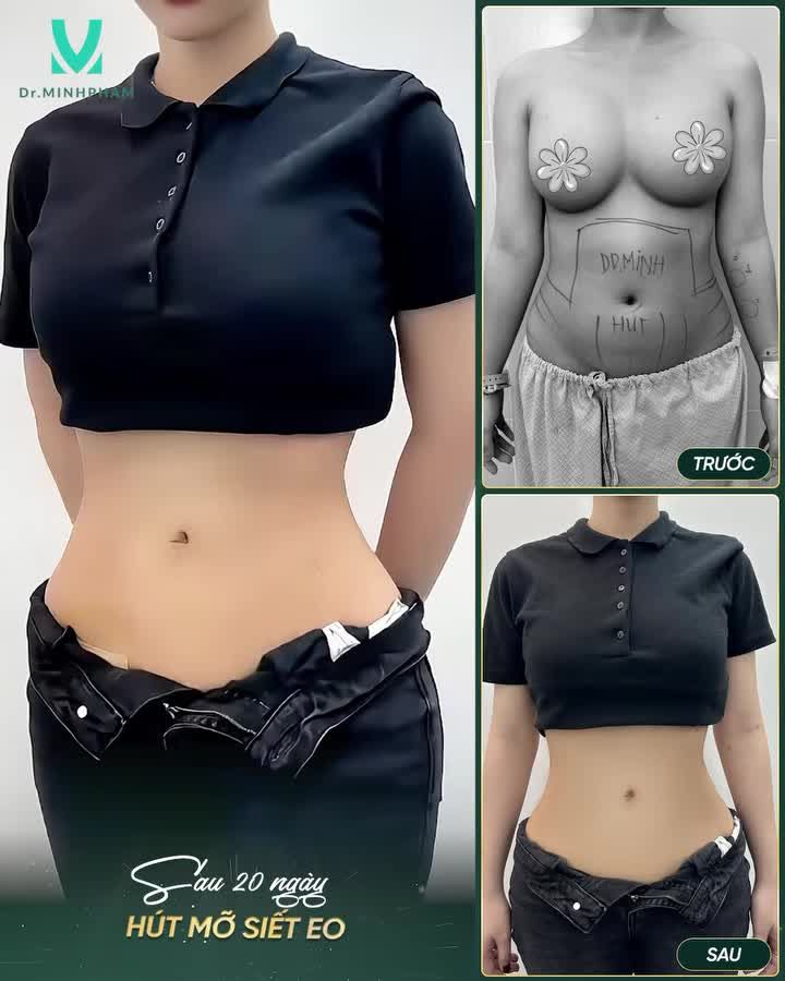 VỀ SIZE XXS SAU 20 NGÀY HÚT MỠ SIẾT EO CỦA CHỊ KHÁCH HÀNG NHÀ DR. MINH PHẠM